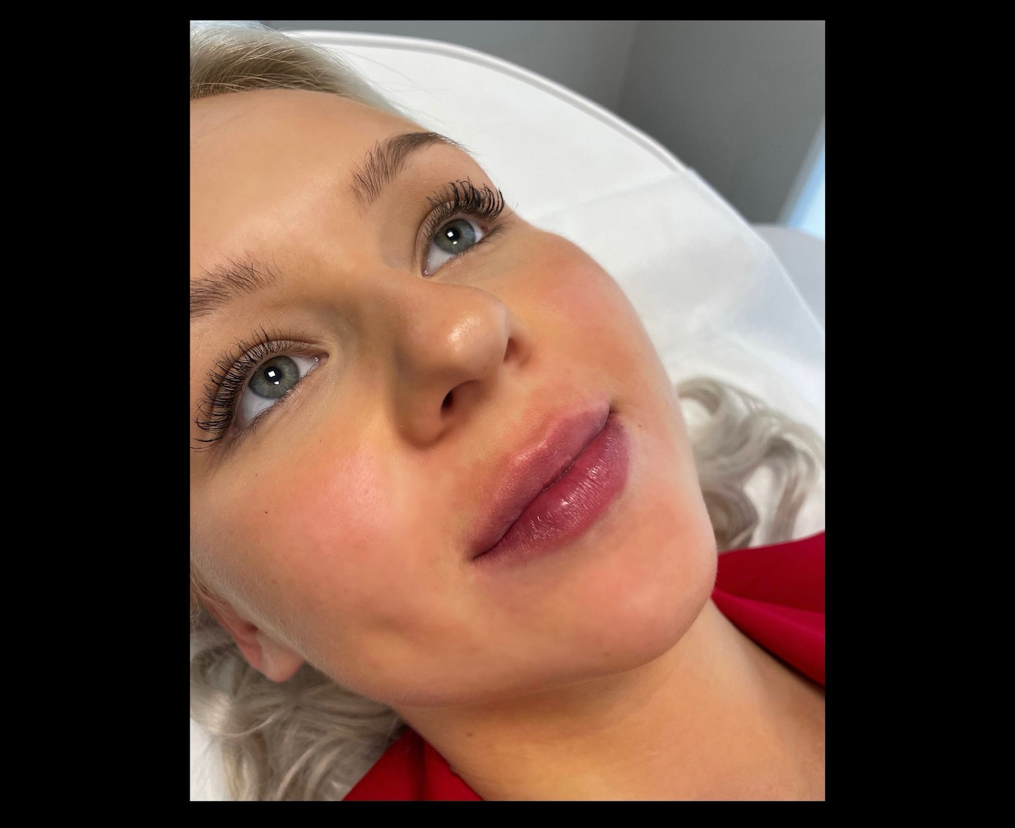Lip Filler in London: Natural Lip Enhancement with Quiet Confidence